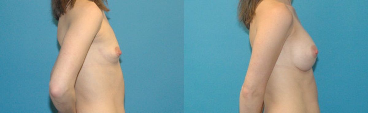 Breast Implant #98 - Before and After
