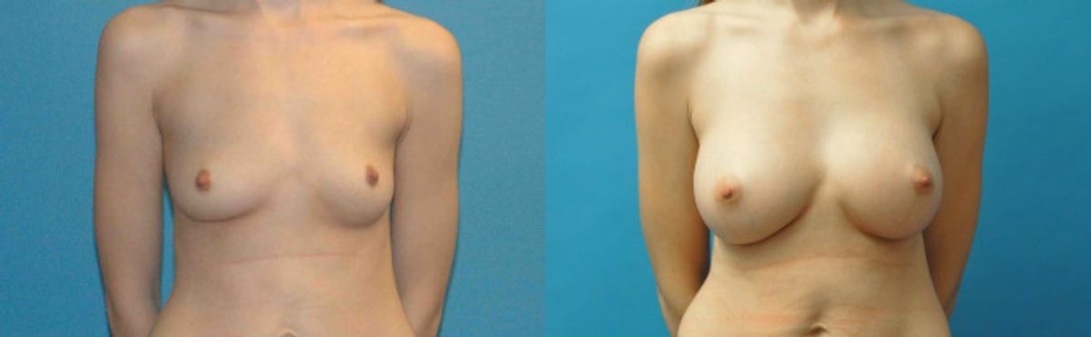 Breast Implant #99 - Before and After