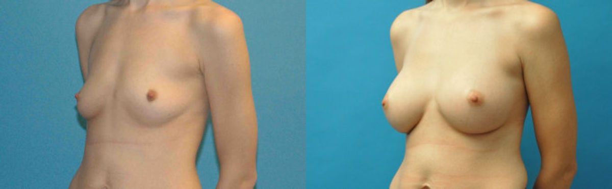 Breast Implant #99 - Before and After