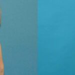 Breast Implant #99 - Before and After