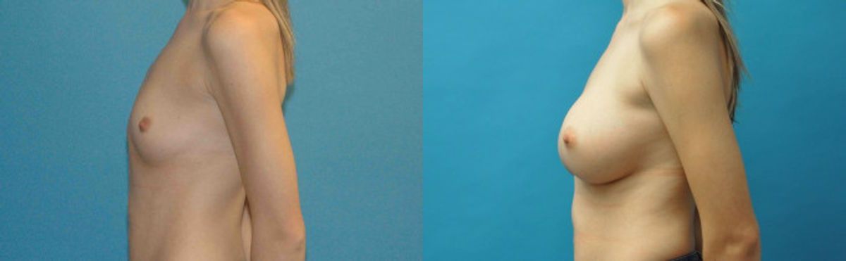 Breast Implant #99 - Before and After