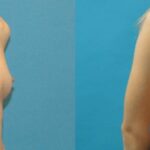 Breast Implant #99 - Before and After