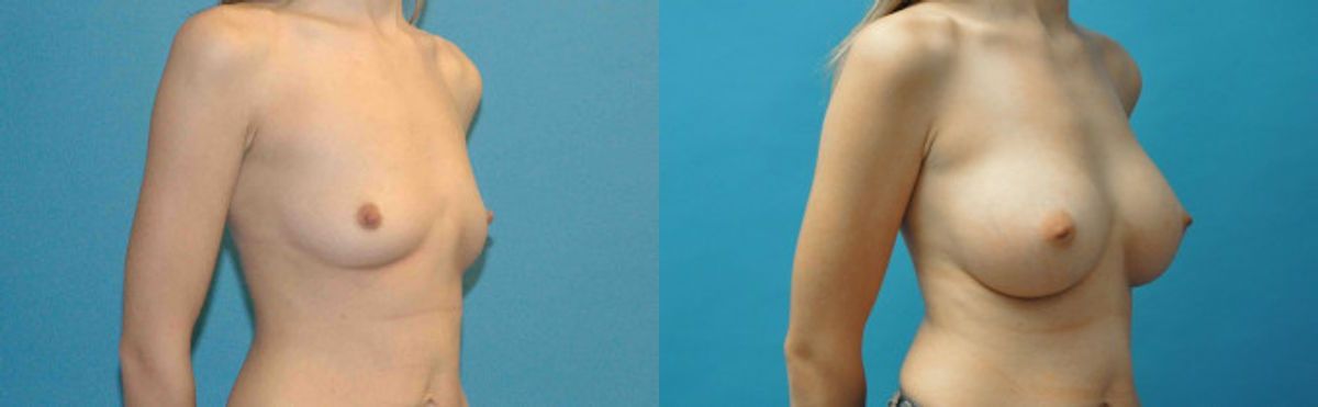Breast Implant #99 - Before and After