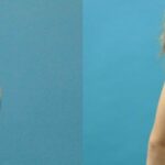 Breast Implant #99 - Before and After