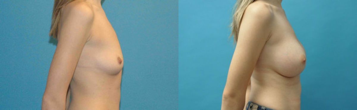 Breast Implant #99 - Before and After