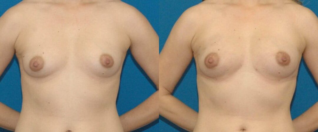 Breast Augmentation with Fat #1