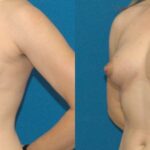 Breast Augmentation with Fat #1 - Before and After