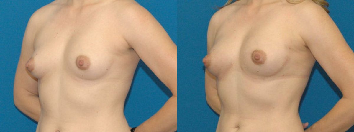 Breast Augmentation with Fat #1 - Before and After