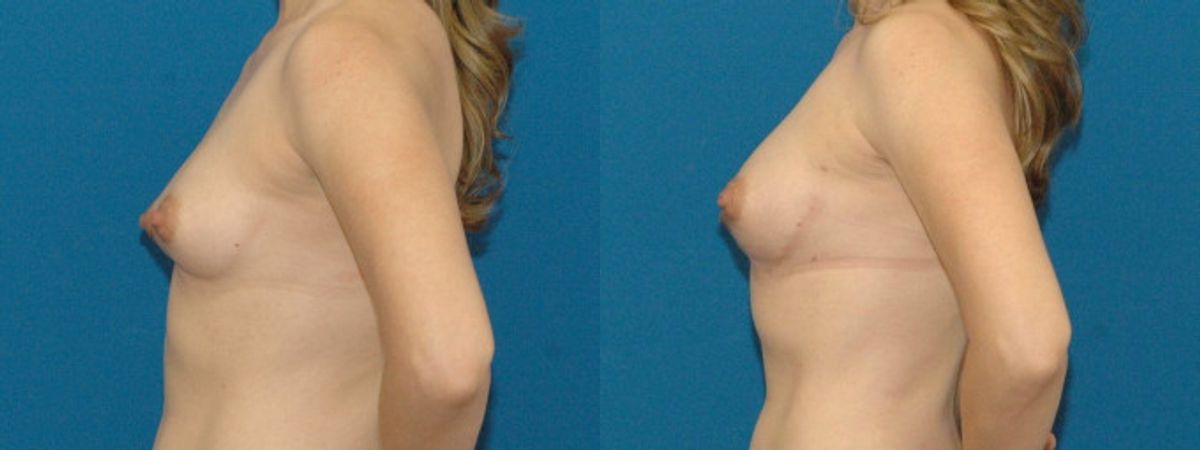 Breast Augmentation with Fat #1 - Before and After