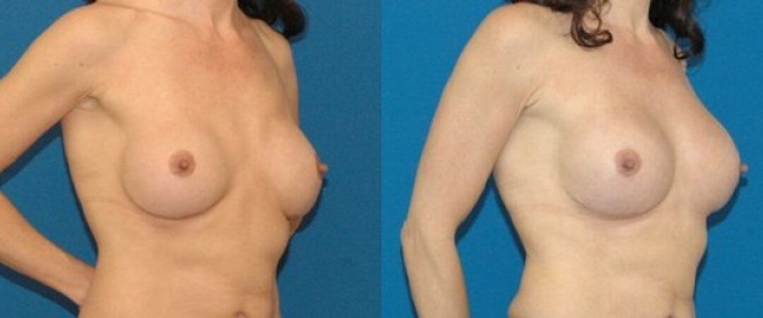 Breast Augmentation with Fat #2
