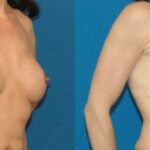 Breast Augmentation with Fat #2 - Before and After