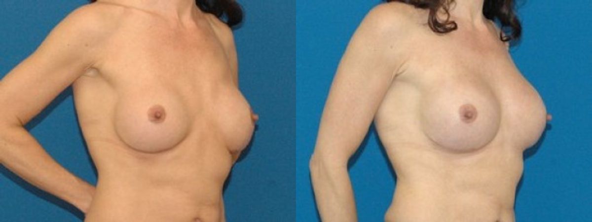 Breast Augmentation with Fat #2 - Before and After