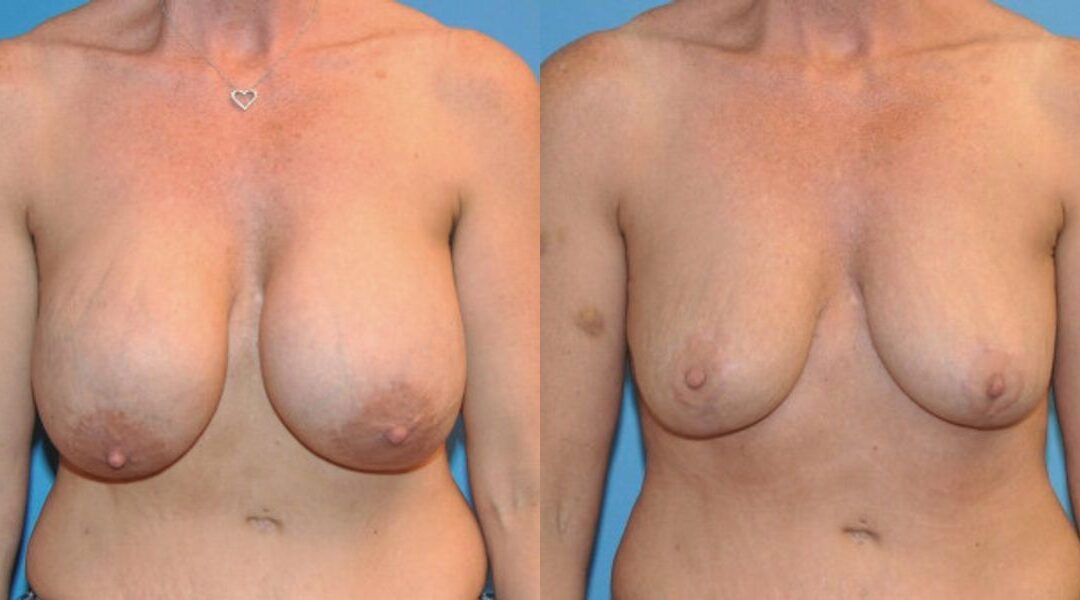 Breast Implant Removal and Lift #1