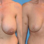 Breast Implant Removal and Lift #1 - Before and After