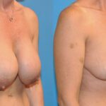 Breast Implant Removal and Lift #1 - Before and After
