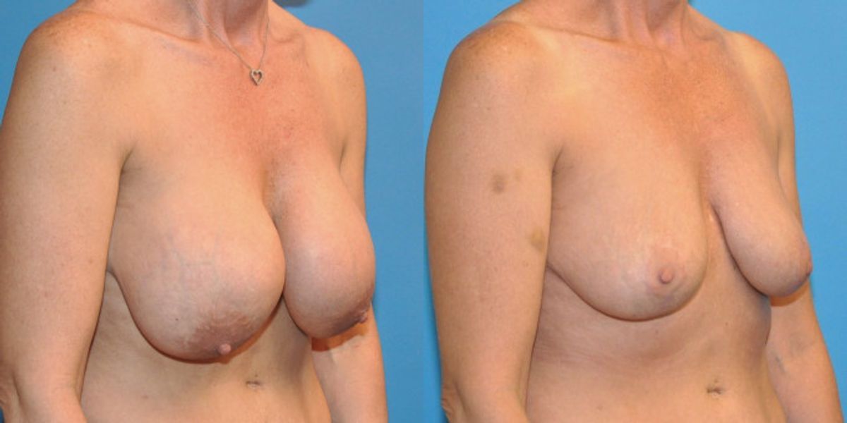 Breast Implant Removal and Lift #1 - Before and After