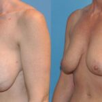 Breast Implant Removal and Lift #1 - Before and After