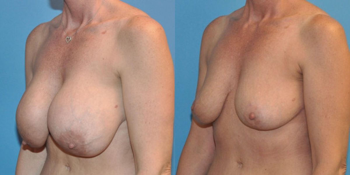 Breast Implant Removal and Lift #1 - Before and After