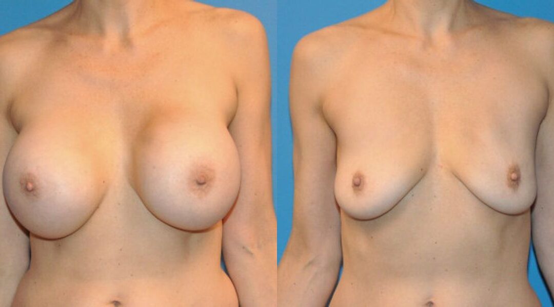 Breast Implant Removal #2