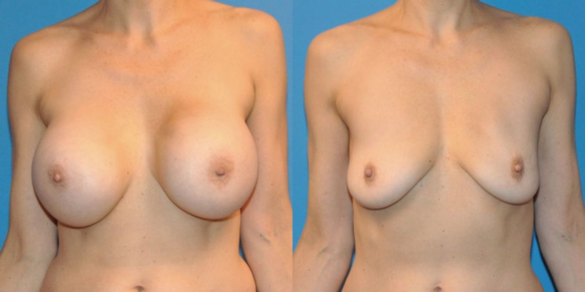 Breast Implant Removal #2 - Before and After
