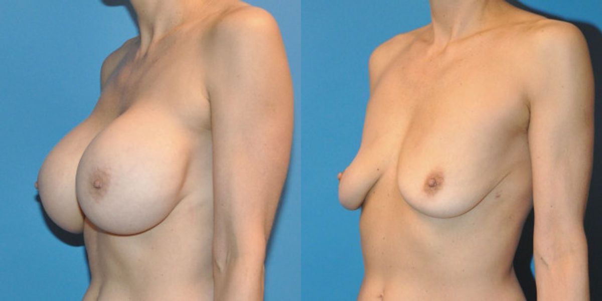 Breast Implant Removal #2 - Before and After