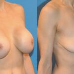 Breast Implant Removal #2 - Before and After