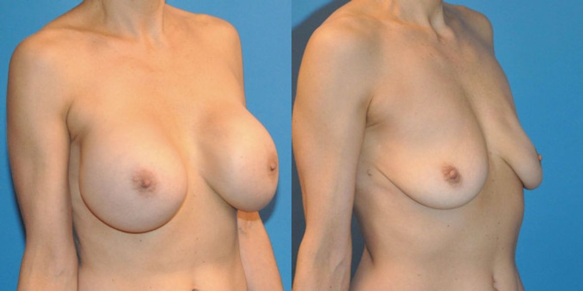 Breast Implant Removal #2 - Before and After