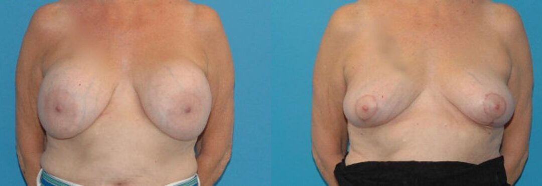 Breast Implant Removal and Lift #3