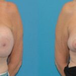 Breast Implant Removal and Lift #3 - Before and After