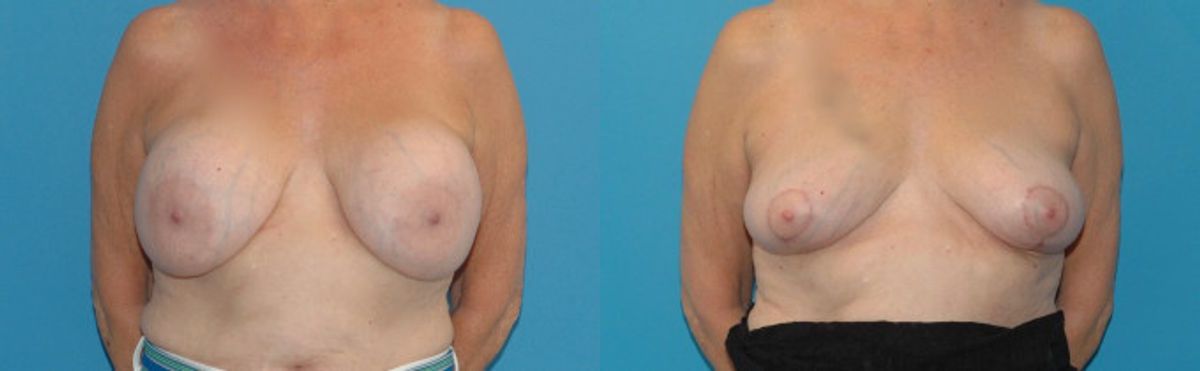Breast Implant Removal and Lift #3 - Before and After