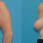 Breast Implant Removal and Lift #3 - Before and After