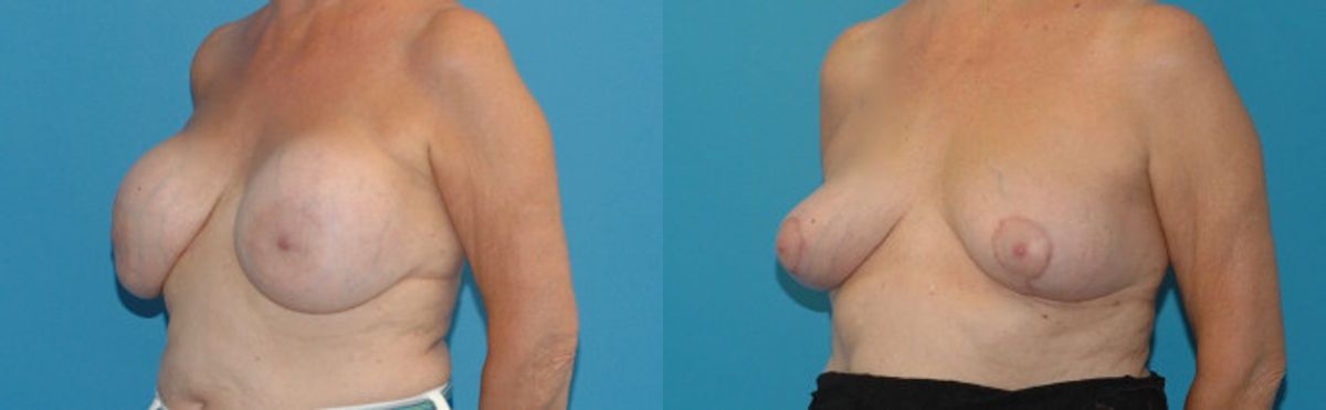 Breast Implant Removal and Lift #3 - Before and After