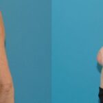 Breast Implant Removal and Lift #3 - Before and After