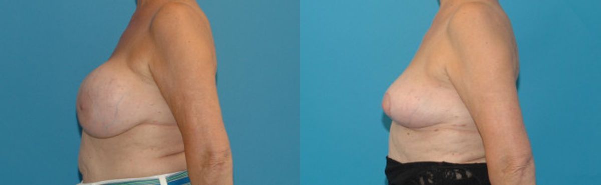 Breast Implant Removal and Lift #3 - Before and After
