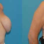 Breast Implant Removal and Lift #3 - Before and After