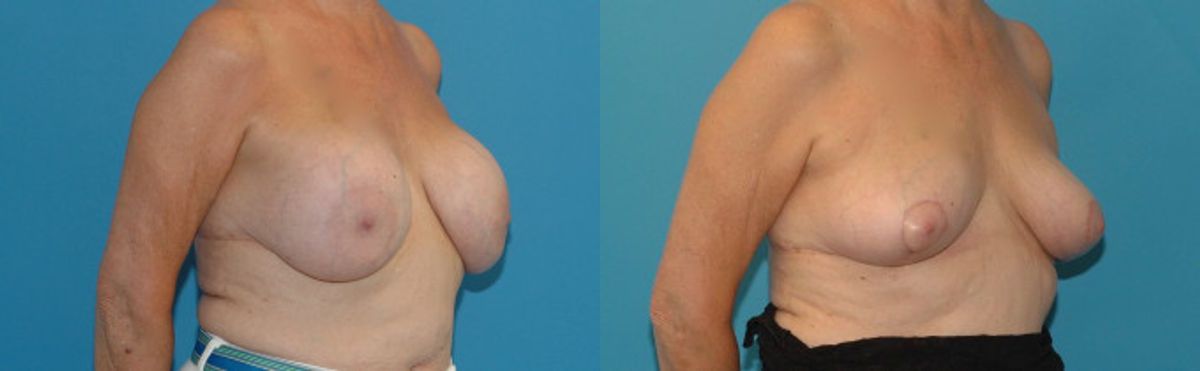 Breast Implant Removal and Lift #3 - Before and After