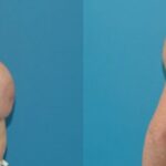 Breast Implant Removal and Lift #3 - Before and After