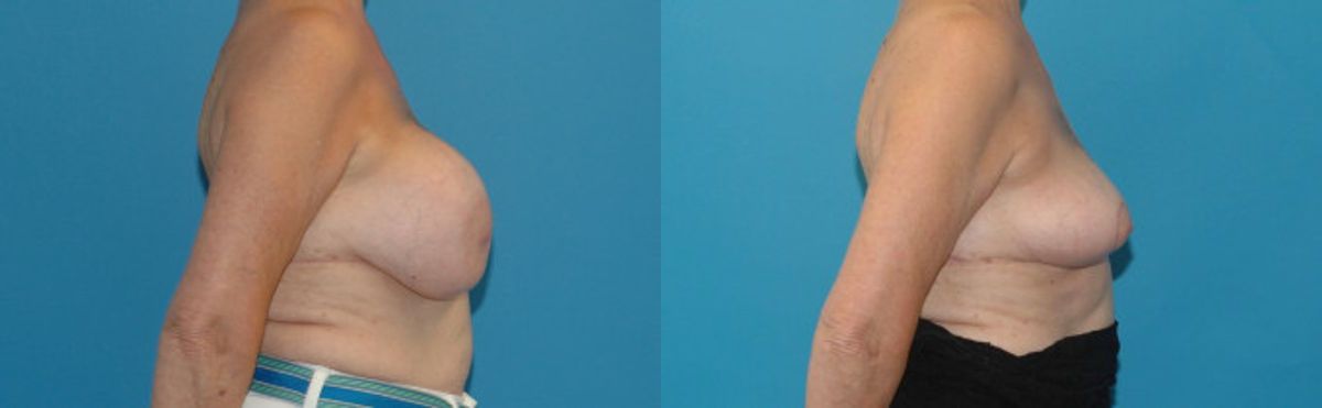 Breast Implant Removal and Lift #3 - Before and After