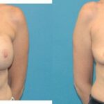 Breast Implant Removal #4 - Before and After