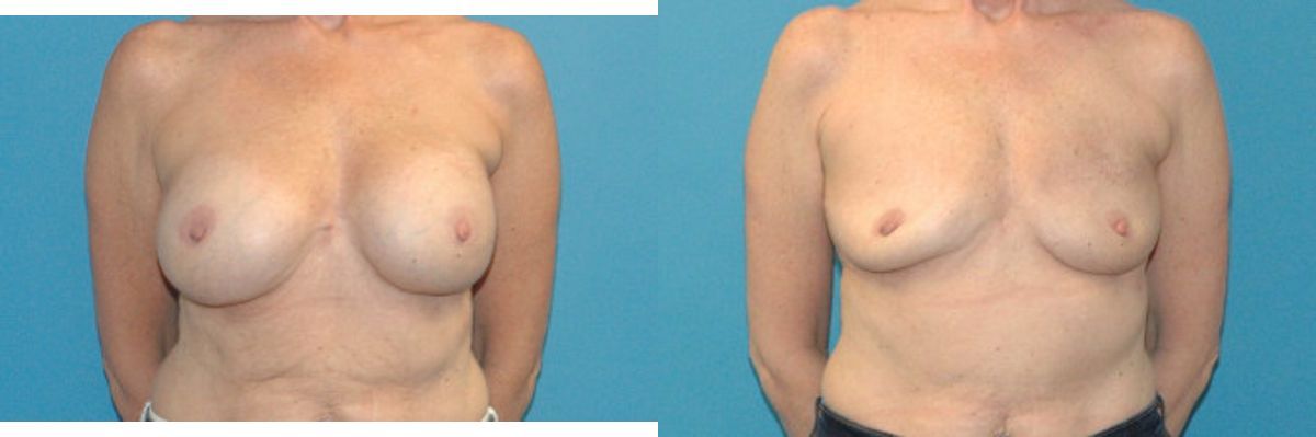 Breast Implant Removal #4 - Before and After
