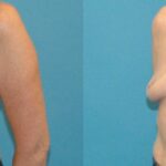 Breast Implant Removal #4 - Before and After