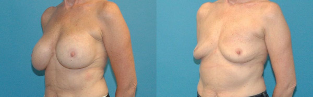 Breast Implant Removal #4 - Before and After