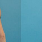 Breast Implant Removal #4 - Before and After