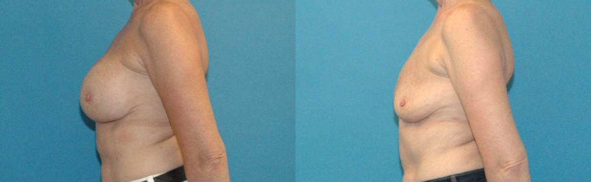 Breast Implant Removal #4 - Before and After