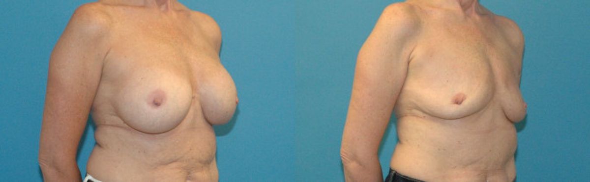Breast Implant Removal #4 - Before and After