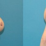 Breast Implant Removal #4 - Before and After