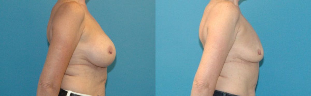 Breast Implant Removal #4 - Before and After