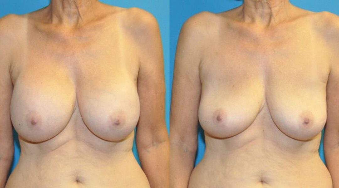 Breast Implant Removal #5