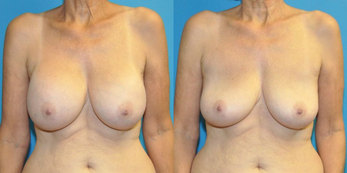 Breast Implant Removal #5 - Before and After