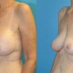 Breast Implant Removal #5 - Before and After